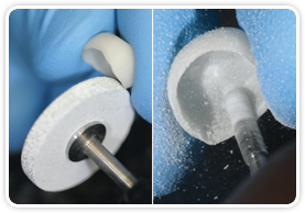 The KidCadCrowns® 2.0 can be customized, fitting the preparation The KidCadCrowns® 2.0 can be customized, fitting the preparation