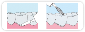 The crowns' edges can also be adjusted after the composite has set The crowns' edges can also be adjusted after the composite has set